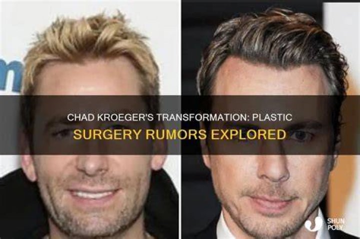Chad Kroeger’s Plastic Surgery The 48YearOld Canadian Singer’s