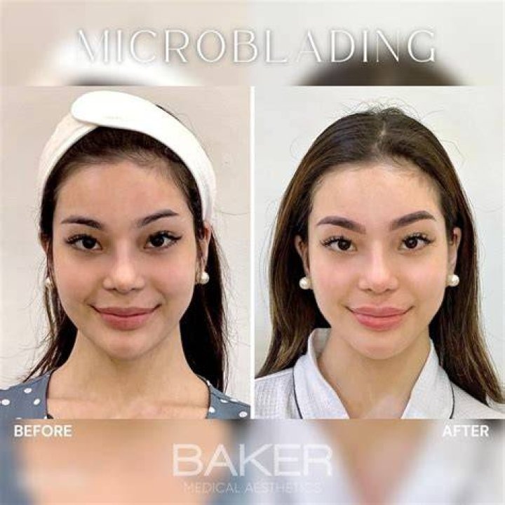 Kitty Duterte Nose Job Before And After Surgery Photos