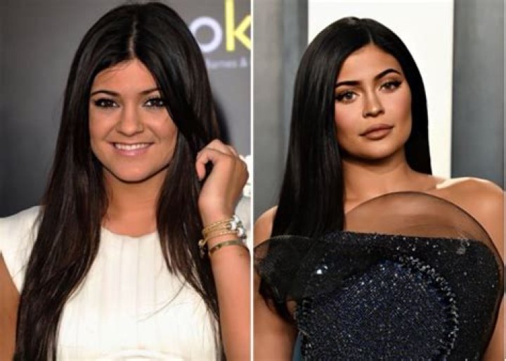 Kylie Jenner Before And After Plastic Surgery Photos