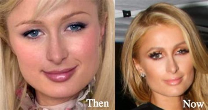 Paris Hilton Plastic Surgery Before and After